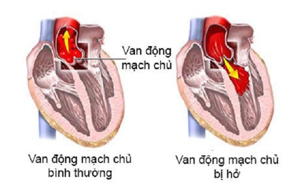 Hở van động mạch chủ - Hình ảnh minh họa
